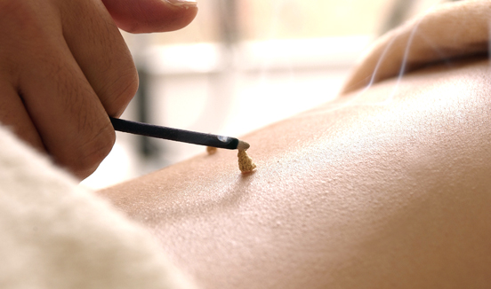 Moxibustion / Acupuncture